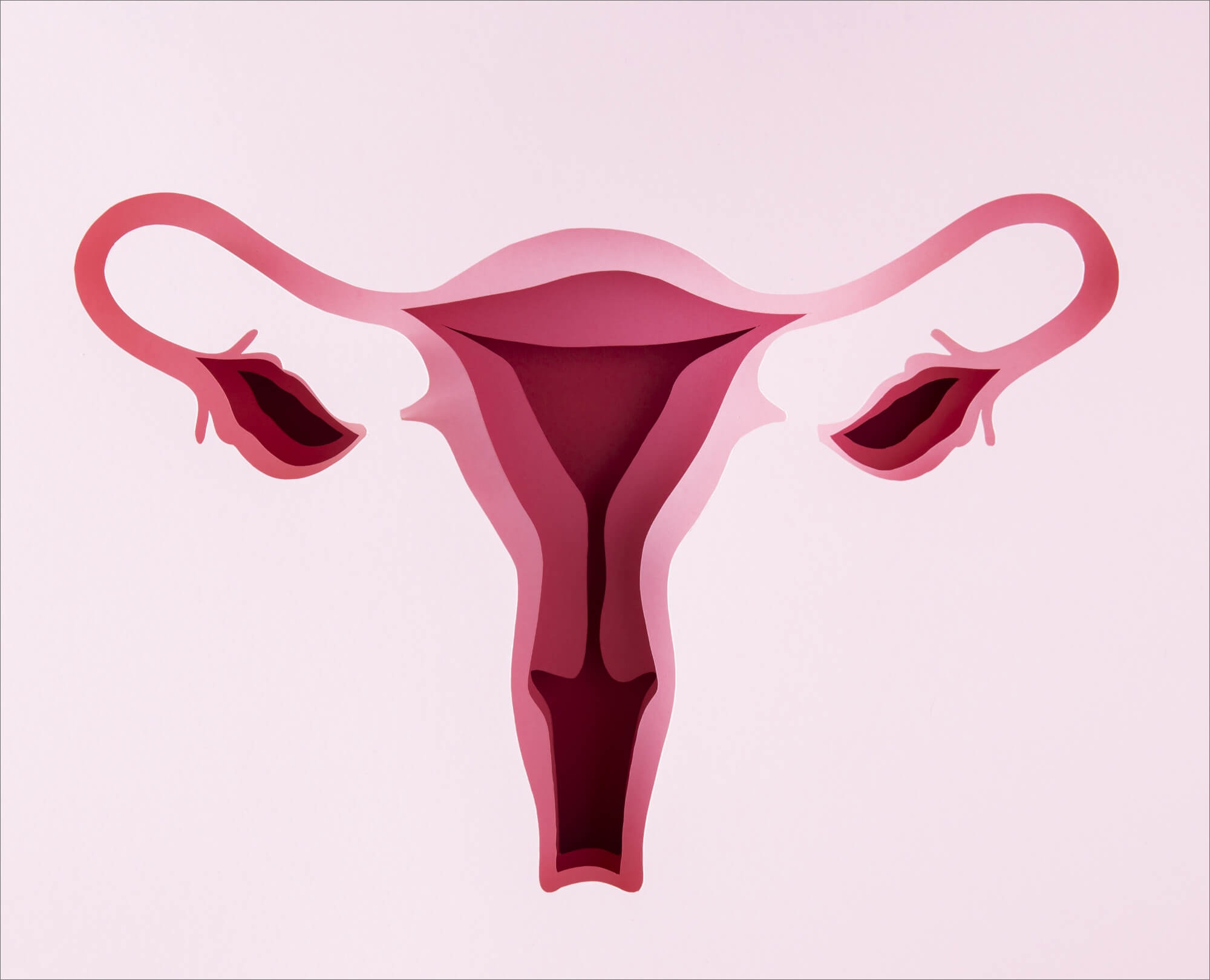 PCOS