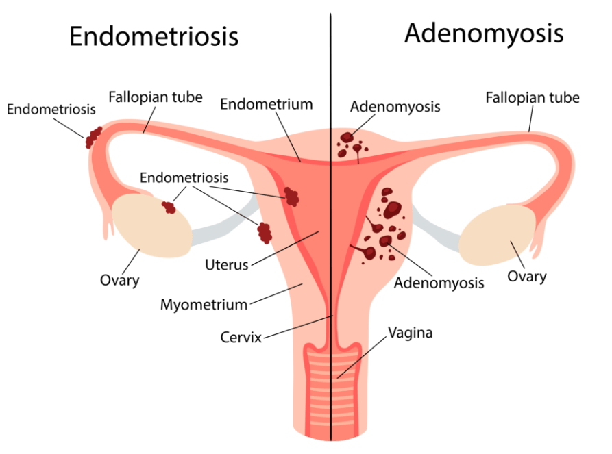 Adenomyosis vs Endometriosis | Northside Gynaecology