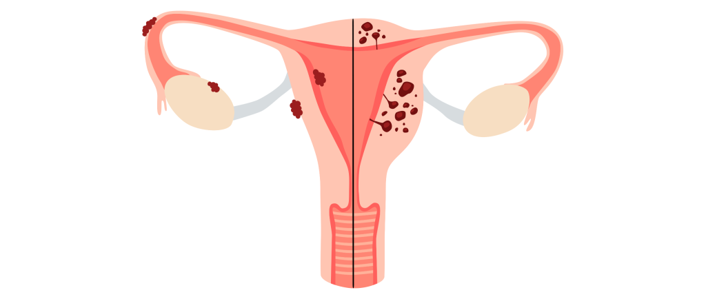 Adenomyosis vs Endometriosis | Northside Gynaecology